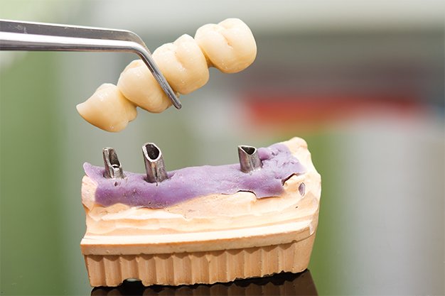 Dental bridge model positioned above implant posts on a dental cast