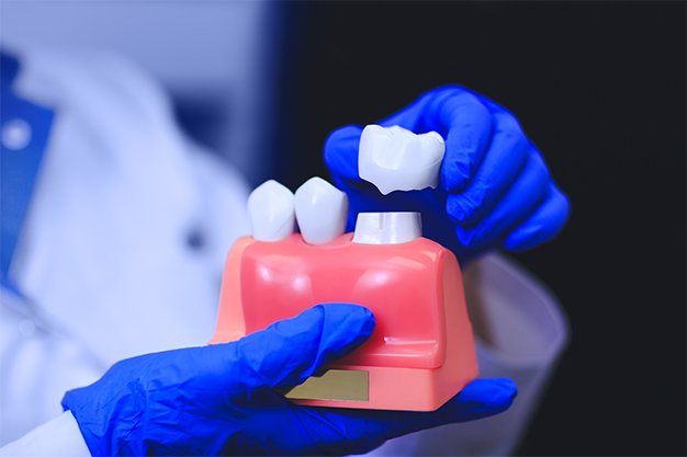 Dental Crowns In Sarasota, Fl 1 Dental crown model shown above a prepared tooth model