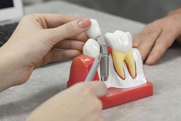 Dental implant model showing implant, abutment, and crown