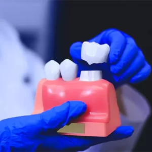 Dental crown and abutment model