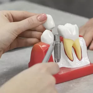 Dental implant model showing an implant post