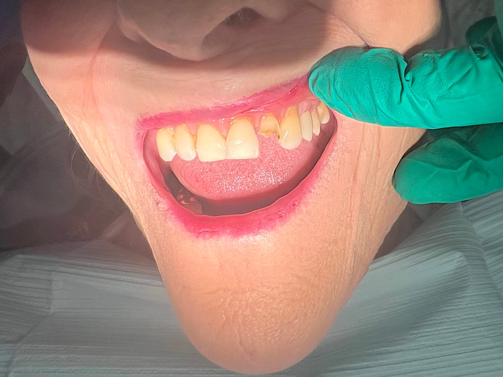 Broken tooth before treatment at Z Family Dental in Sarasota, FL