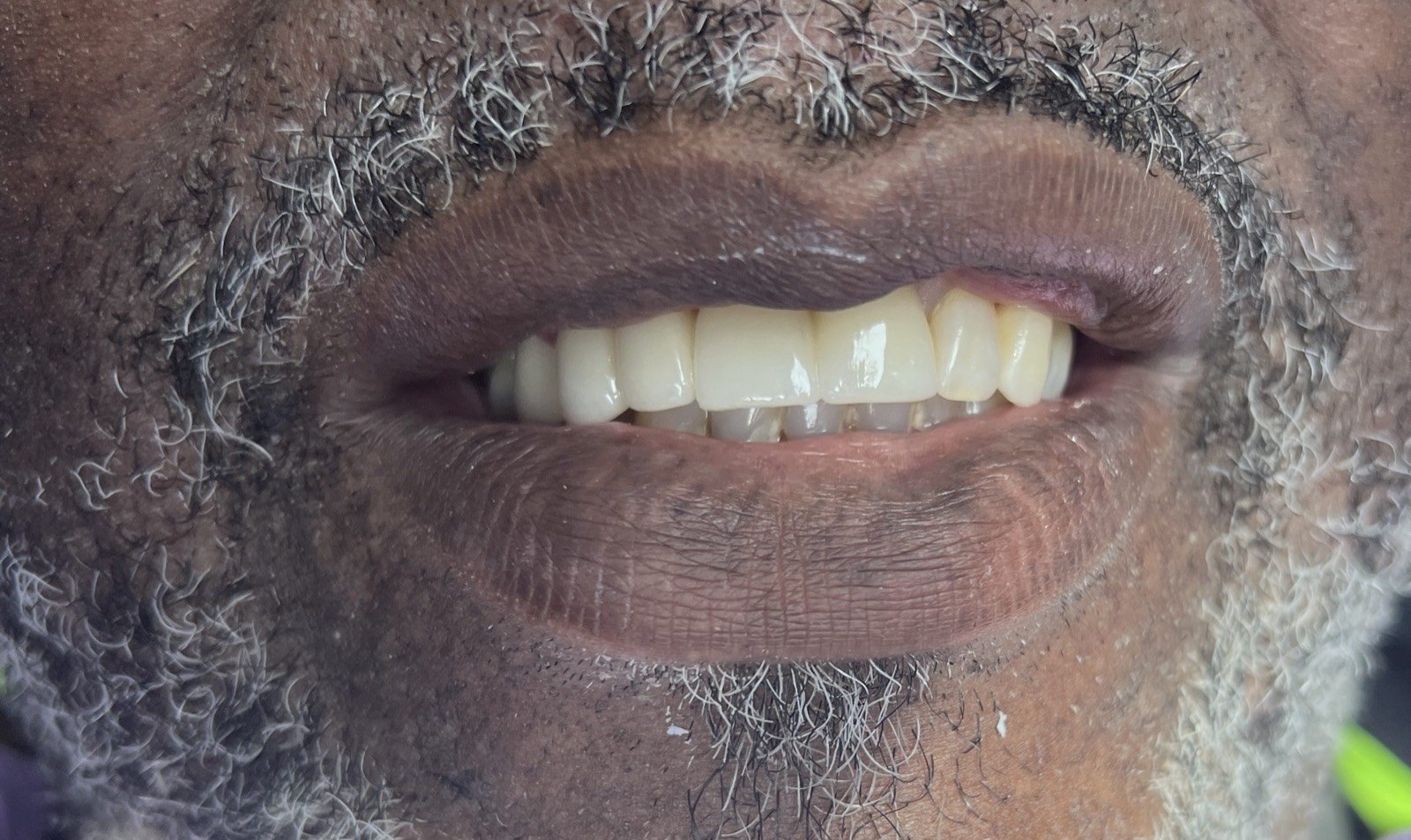 Dental bridge result after replacement treatment