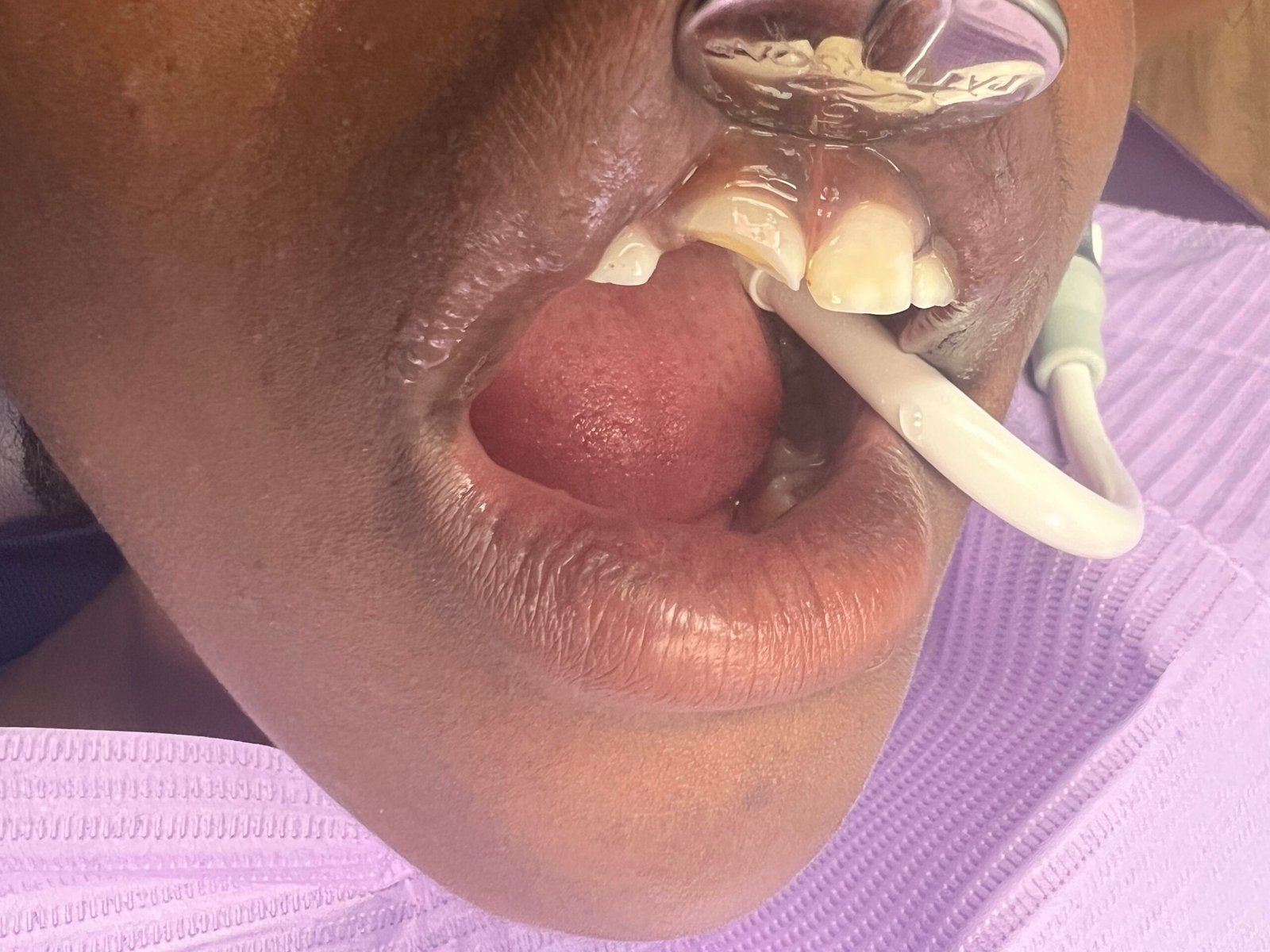Dental emergency before treatment at Z Family Dental in Sarasota, FL