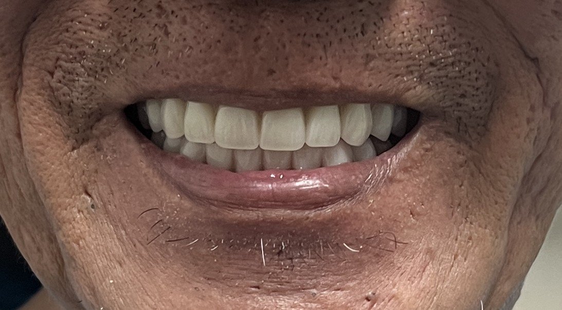 A natural-looking denture smile after treatment