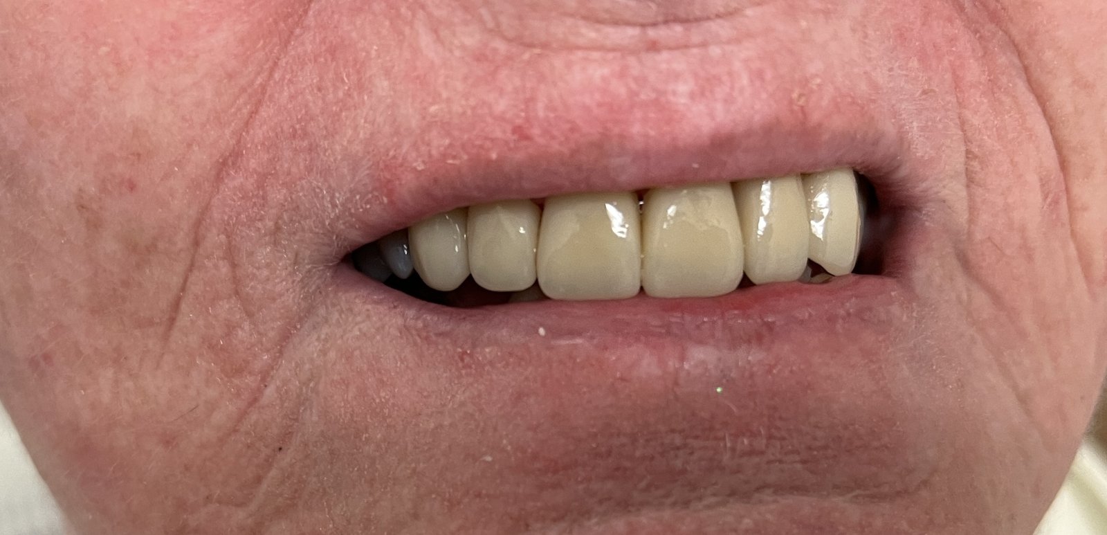 Smile makeover result for porcelain veneers planning