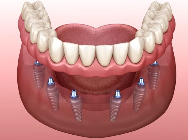 Implant-supported denture example