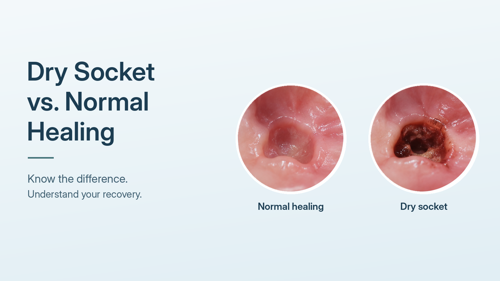 Illustration comparing tooth extraction healing and dry socket